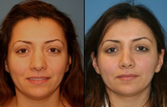 Ethnic Rhinoplasty