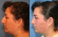 Dorsal Hump Reduction