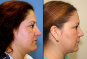 Dorsal Hump Reduction