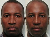 Ethnic Rhinoplasty - African American Male