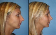 Rhinoplasty