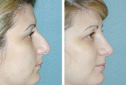 Rhinoplasty