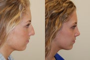 Rhinoplasty