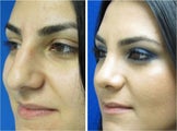 Rhinoplasty