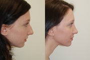 Rhinoplasty Surgery. 4 months post-op.
