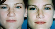 Rhinoplasty