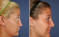 Rhinoplasty