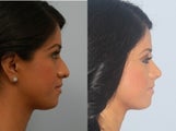 Rhinoplasty