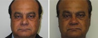 Rhinoplasty