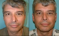 Rhinoplasty