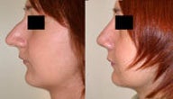 Rhinoplasty
