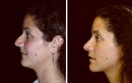 28 year old female, rhinoplasty