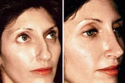 25 year old female, rhinoplasty