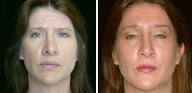 45 year old female, rhinoplasty