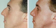 Rhinoplasty