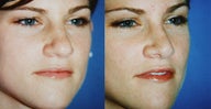 Rhinoplasty
