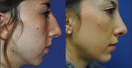 Rhinoplasty