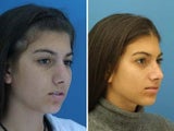 Rhinoplasty side profile of a younger girl