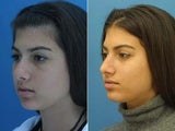 Rhinoplasty side profile of tip of nose