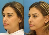 Rhinoplasty side profile of bridge of nose