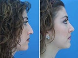 Rhinoplasty side profile of bridge and tip of nose