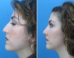 Rhinoplasty side facial profile of nose