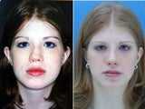 Rhinoplasty front view of tip of nose