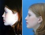Rhinoplasty side view of nose and facial features