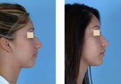 Rhinoplasty