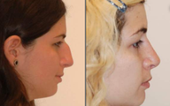 Rhinoplasty, profile view