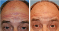 Scar Revision