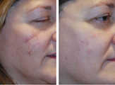 Scar Revision