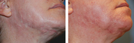 Scar Revision