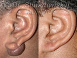 Keloid Removal
