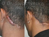 Keloid Removal