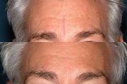 Fraxel re:store treatment for scar
