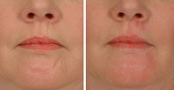 Restylane Scar Injection