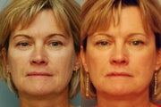 Three vials Sculptra