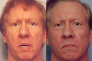 Before and after Sculptra