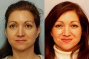 Sculptra treatment for cheeks