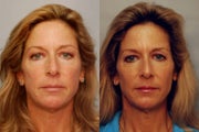 Sculptra to cheek areas