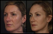 Sculptra for Volume and Contouring