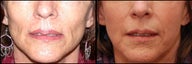 Sculptra