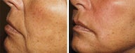Sculptra for facial wrinkles