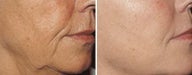 Sculptra for wrinkles around the mouth