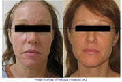 Sculptra Los Angeles