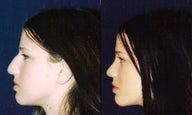 Septoplasty