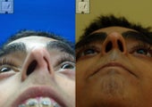 Septoplasty
