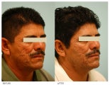 Acne Scarring Correction