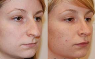 Rhinoplasty and Lip Enhancement with Silikon-1000